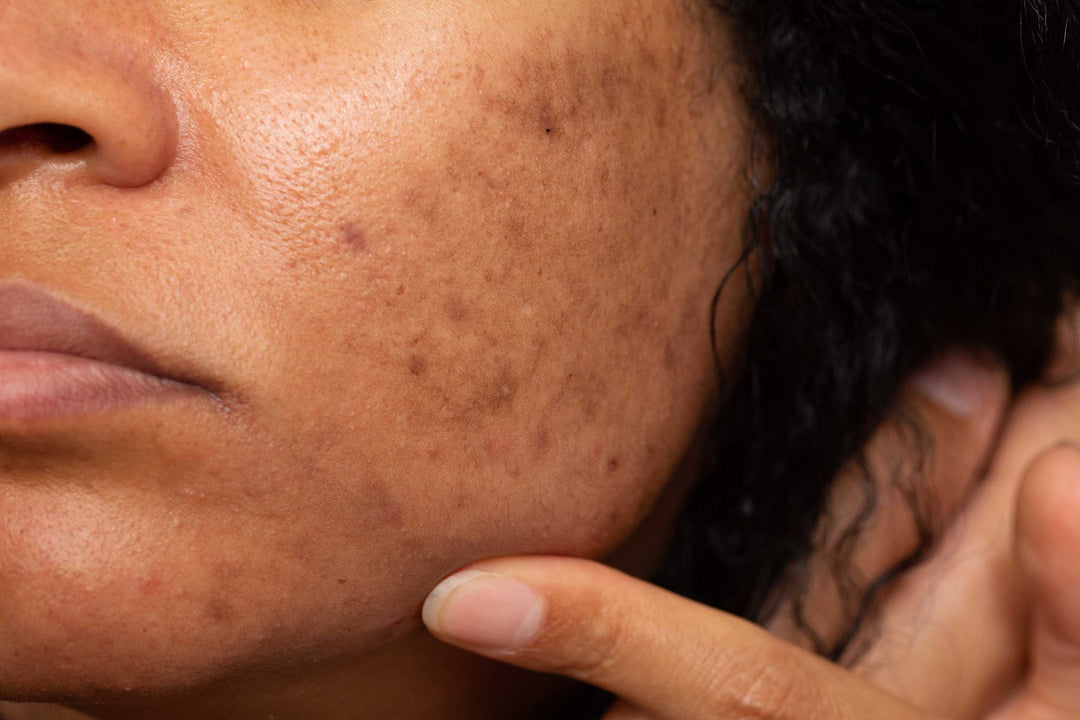 Comment lutter efficacement contre l’hyperpigmentation